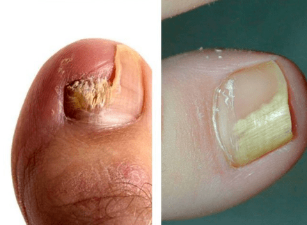 Enfermedad del hongo