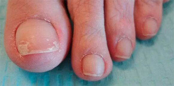 Fases de las piernas de hongos