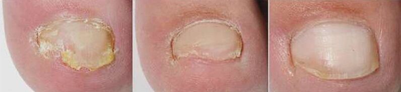 Resultados de la terapia