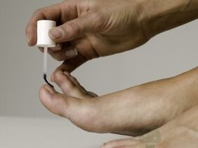 Tratamiento del hongo de las uñas