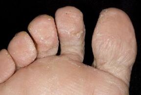 Síntomas de un hongo en la piel de los pies.