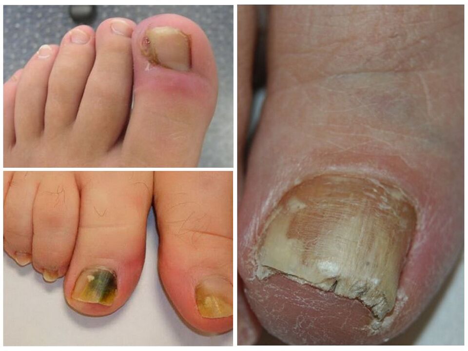 Infección por hongos en las uñas de los pies.