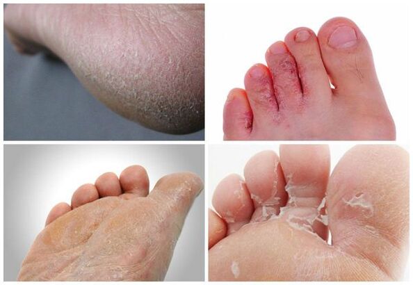 Los principales síntomas de la micosis de los pies son la queratinización de la piel, grietas y descamación.