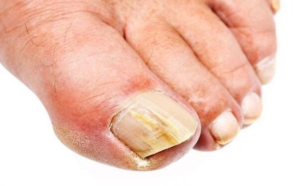 Onicomicosis – hongos en las uñas de los pies