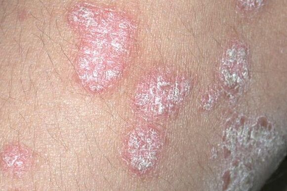 Psoriasis causada por una infección por hongos