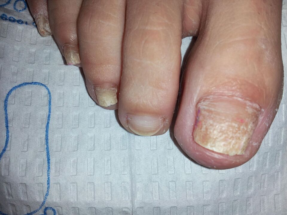 Cómo tratar los hongos en las uñas de los pies con celidonia