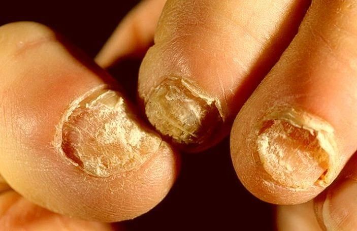 Hongos en las uñas como tratar.