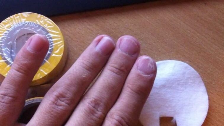 Hongos en las uñas y su tratamiento con remedios caseros.