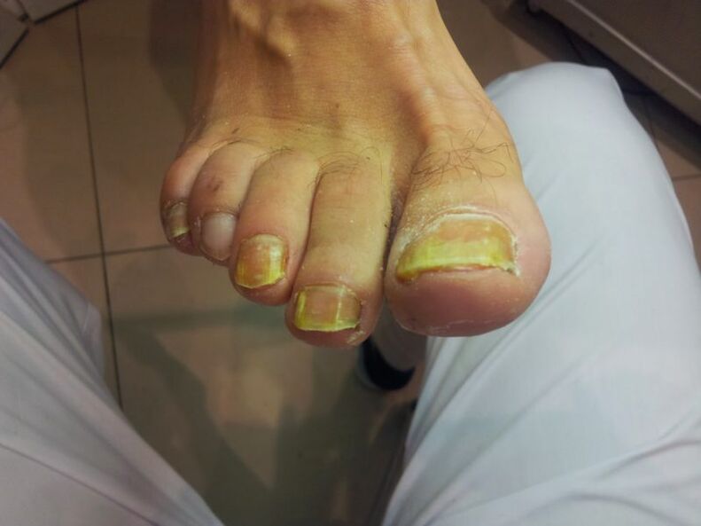 Uñas de los pies amarillas debido a hongos.